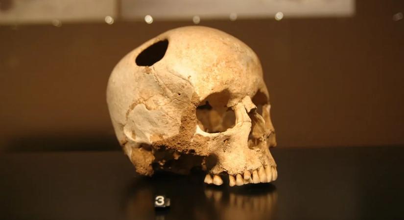 A sebészet története – Agydaganatos vikingek, koponyalékelés és aranyorrú császárok a múltban