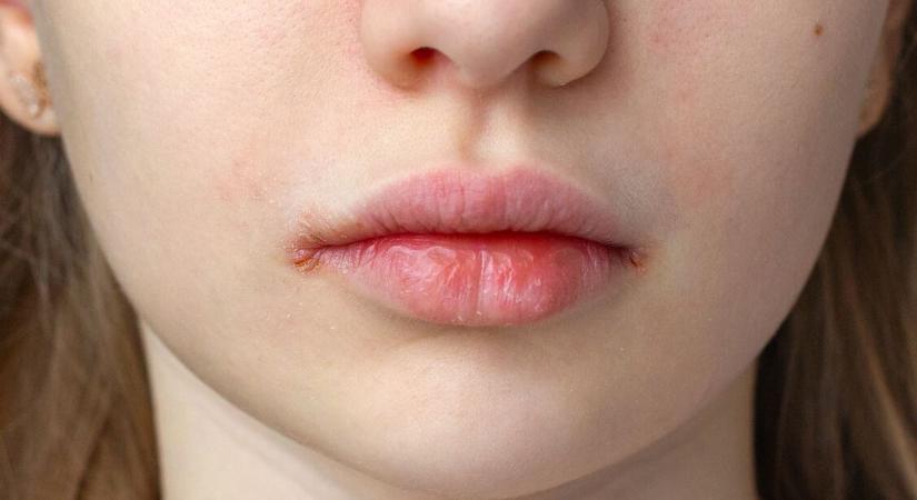 Ez a tünet a száj sarkában komoly fertőzést jelezhet — sokan herpesznek hiszik