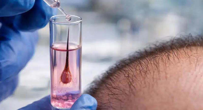 Kémcsőből a fejbőrre – teljesen működő hajhagymát hoztak létre a laborban