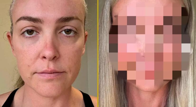 „Valaki FIZETETT ezért?”: Szétszedik a nőt a plasztika előtti és utáni képe miatt