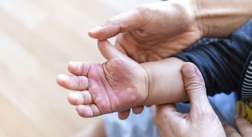 Hogyan lássuk el a gyermekek sérüléseit? Hiánypótló előadás szülőknek