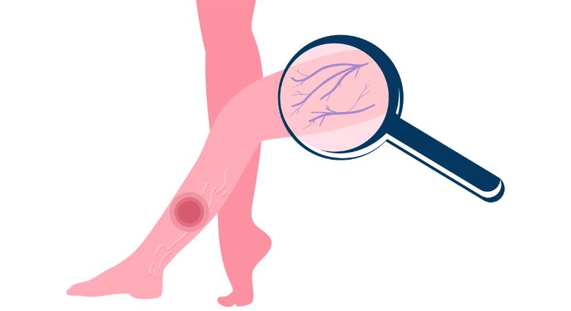 El lehet-e vérezni visszeres vérzésben?