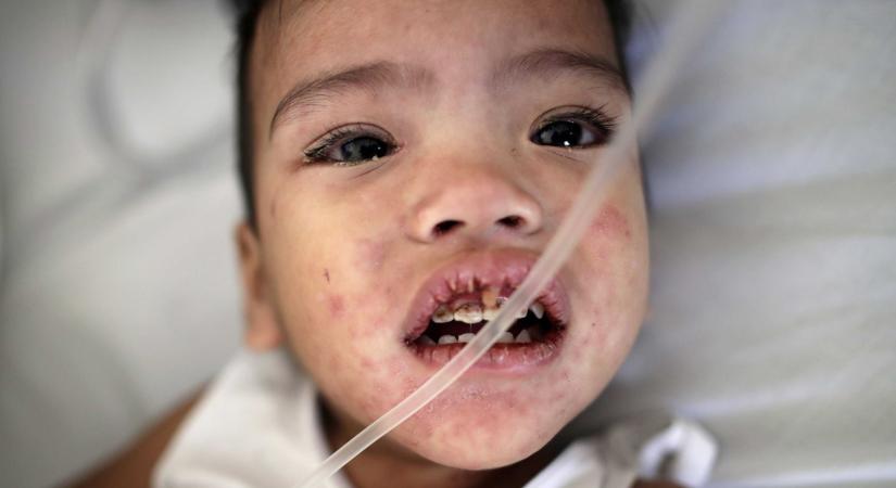 Amerika letérdelt a kanyaró előtt