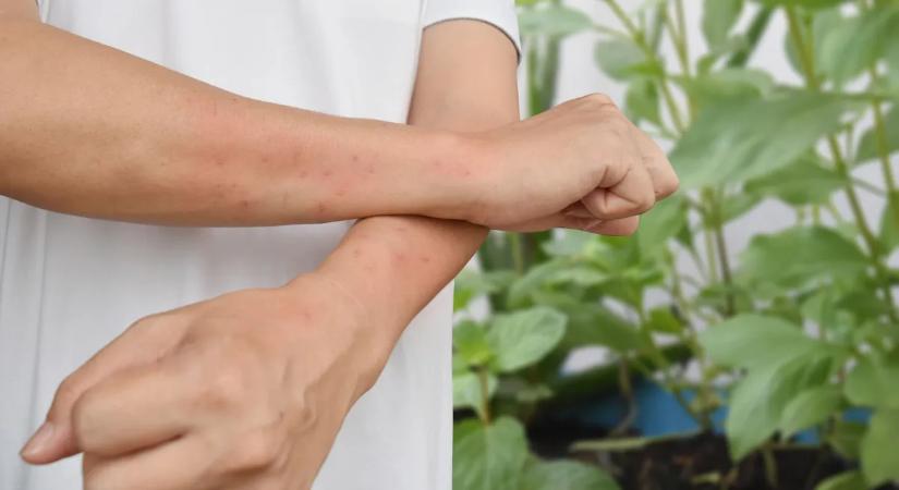 Megcsípett a csalán? Így kezelheted házi módszerekkel