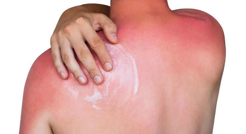 Fényérzékenységet okozó gyógyszerek: erre figyelmeztet a gyógyszerész