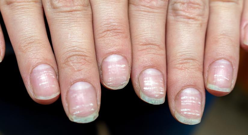 Fehér foltokat látsz a körmeiden? Szinte mindenkinél előfordulhat ez a tünet, de kevesen tudják, mit jelentenek