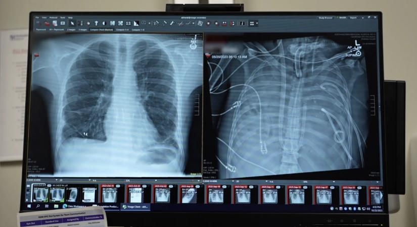 48 órán át élt tüdő nélkül egy férfi, de túlélte