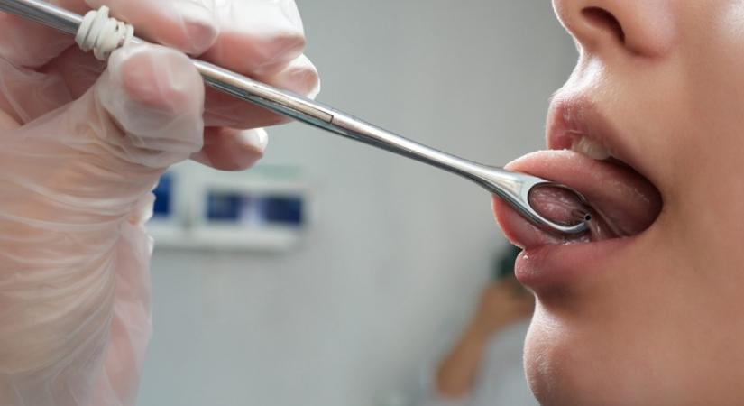 A szájüregi betegségek immár milliárdokat érintenek egy új nemzetközi kutatás szerint