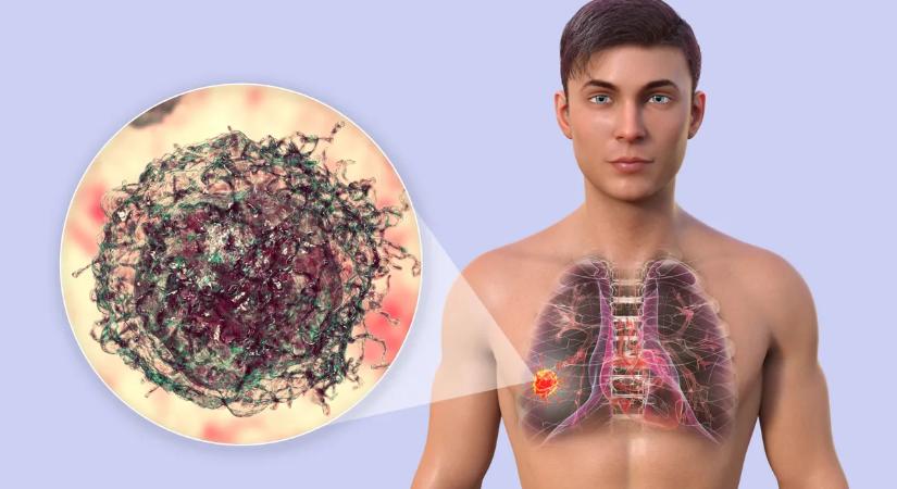 Fordulat a tüdőrák kutatásában: sorsdöntő rejtélyről hullott le a lepel