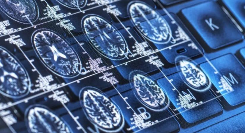 Az MI majdnem 100 százalékos pontossággal megjósolja az Alzheimer-kór kialakulását