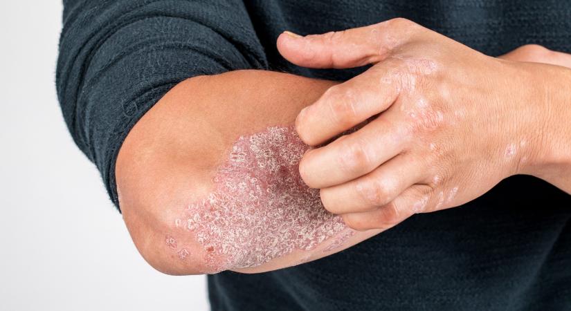 Más terápiára nem reagáló pikkelysömörre fejlesztettek új eljárást