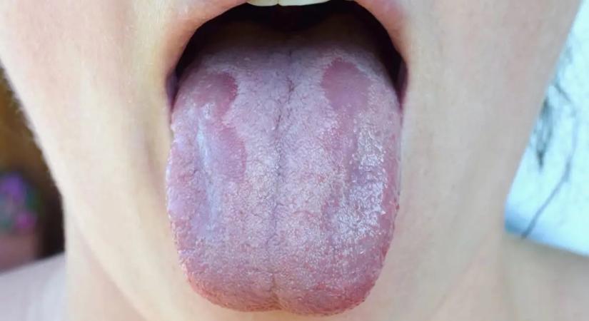 5 változás a nyelven, ami emésztési problémát jelezhet