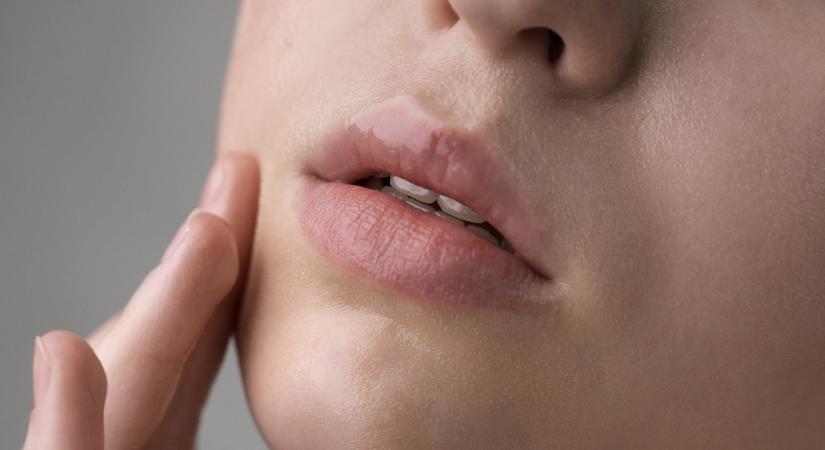 Szájzugrepedés: ezek a tünetek gombás fertőzésre utalhatnak